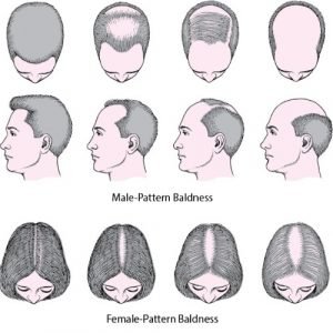 Pattern Baldness Infographic